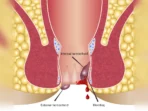 Hemorrhoid