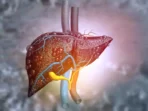 Hepatosteatosis
